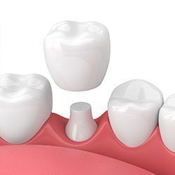 Dental crowns - Laurelhust Family Dentistry