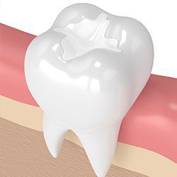 Dental fillings - Laurelhust Family Dentistry