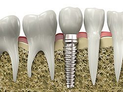 Dental implants - Laurelhust Family Dentistry