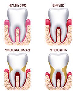 Comparison of healthy gums and those with problems
